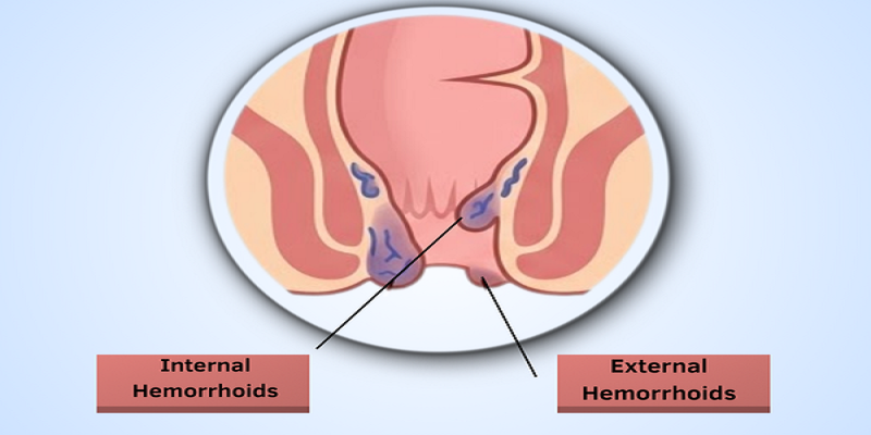 Best Piles Doctor in Sakinaka, Andheri